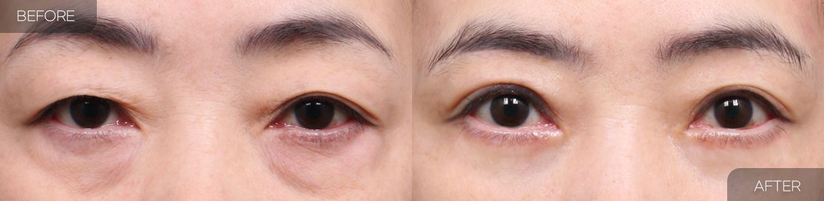 Gambar sebelum dan selepas pembedahan: Pengangkatan Kening 3