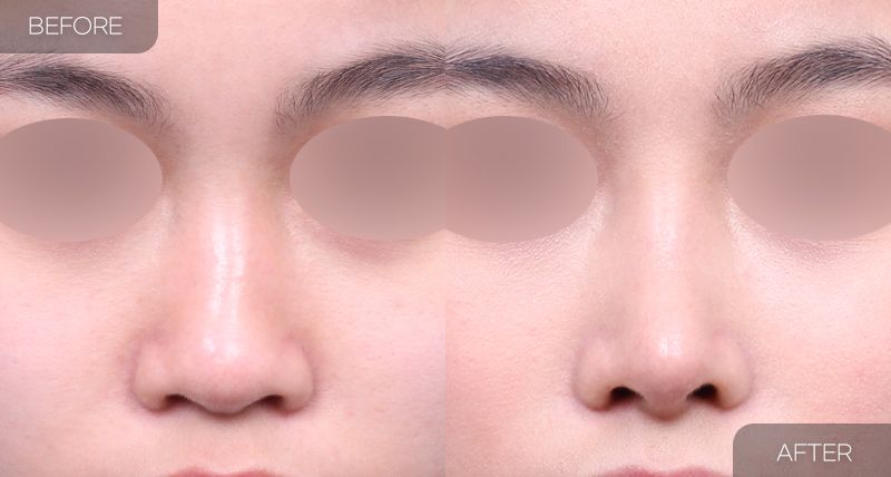 Gambar sebelum dan selepas pembedahan: Hidung Bengkok 3