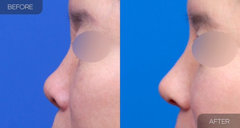 Gambar sebelum dan selepas pembedahan: Hidung Pendek 3