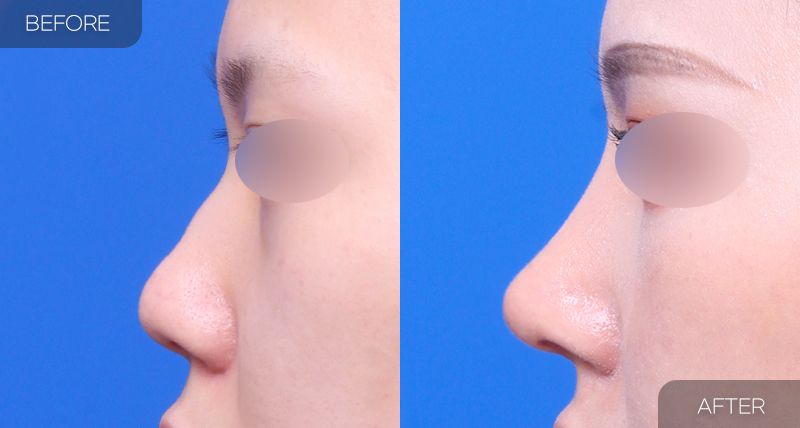 Gambar sebelum dan selepas pembedahan: Hidung Berbonggol 3