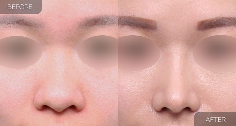 Gambar sebelum dan selepas pembedahan: Hidung Bulbus 3