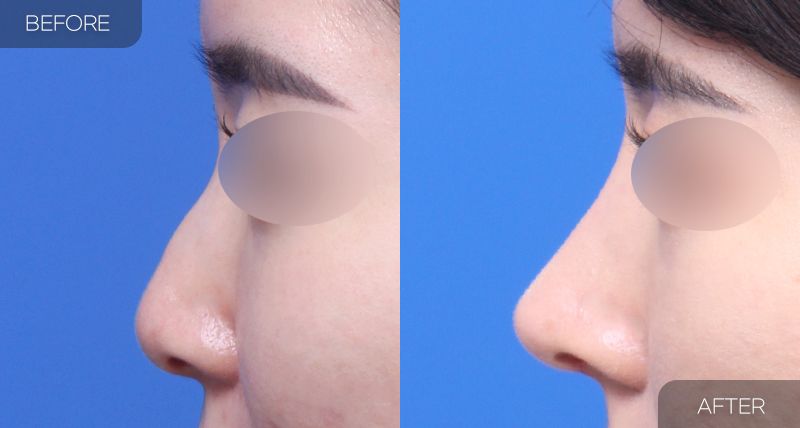 Gambar sebelum dan selepas pembedahan: Pembedahan Semula Hidung 3
