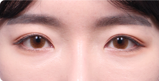 눈재수술 수술 후 1