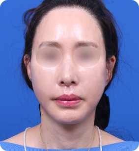 面部提升术正面术后