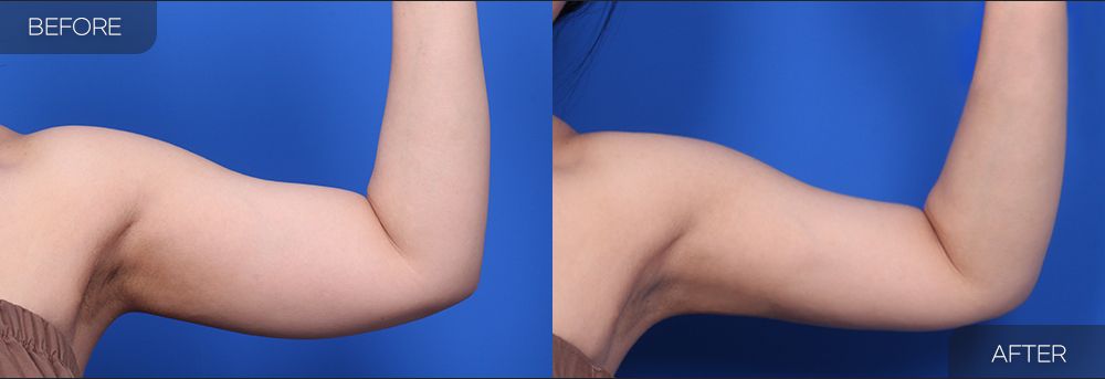Gambar sebelum dan selepas pembedahan: Sedutan Lemak Lengan Atas 3
