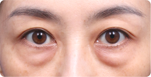 ก่อนผ่าตัดศัลยกรรมหนังตาล่าง