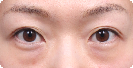 ก่อนผ่าตัดจัดเรียงไขมันใต้ตา+เสริมเยื่อกั้นเบ้าตา