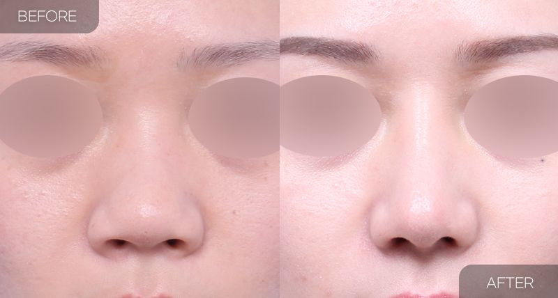 Gambar sebelum dan selepas pembedahan: Pengecilan Cuping Hidung 3