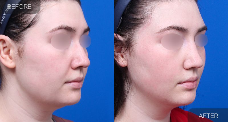 Gambar sebelum dan selepas pembedahan: Mini Facelift 4 (Sudut 45 Darjah)