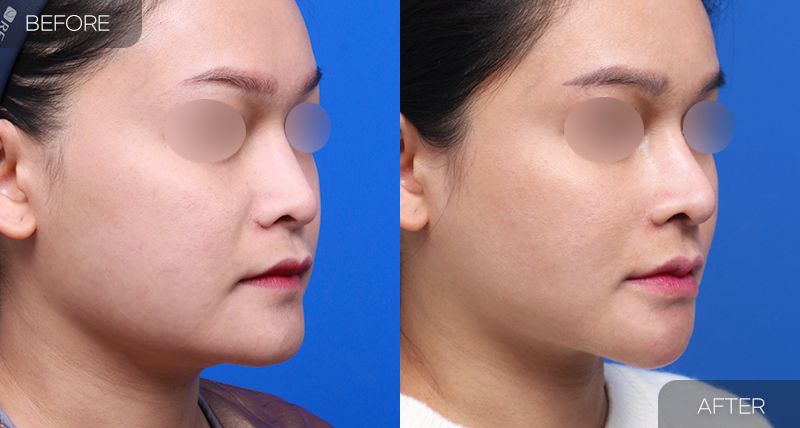 Gambar sebelum dan selepas pembedahan: Thread Lift 4 (Sudut 45 Darjah)