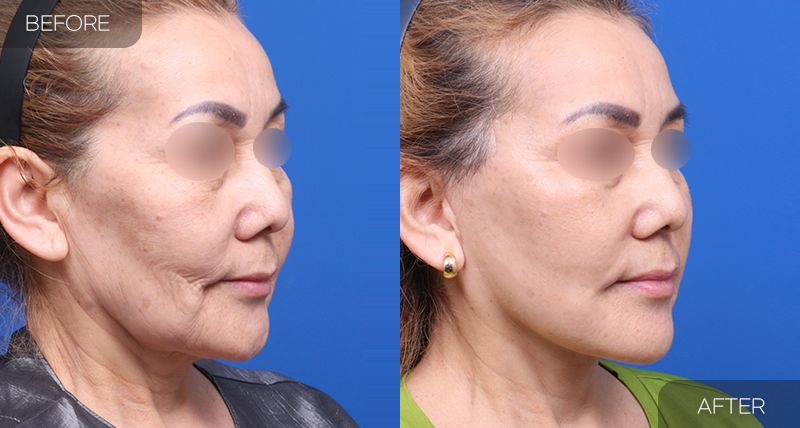 Gambar sebelum dan selepas pembedahan: Facelift Penuh 4 (Sudut 45 Darjah)