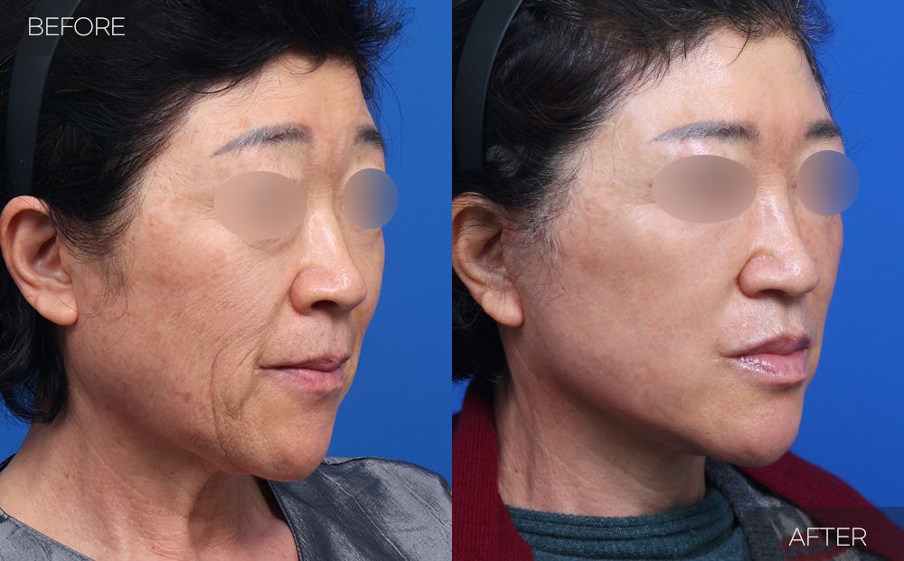Gambar sebelum dan selepas pembedahan: Facelift Separa 4 (Sudut 45 Darjah)