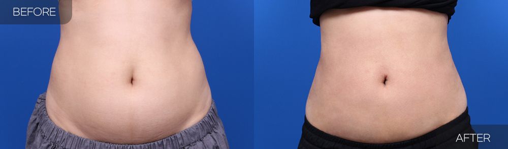 Gambar sebelum dan selepas pembedahan: Sedutan Lemak Abdomen 4 (Pandangan Hadapan)