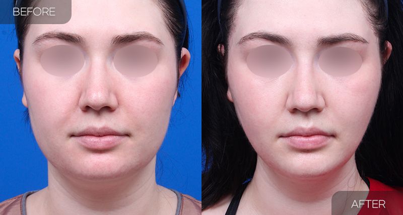 Gambar sebelum dan selepas pembedahan: Mini Facelift 4 (Pandangan Hadapan)