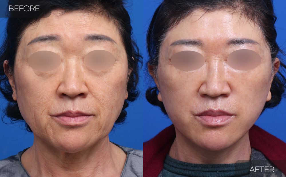 Gambar sebelum dan selepas pembedahan: Facelift Separa 4 (Pandangan Hadapan)