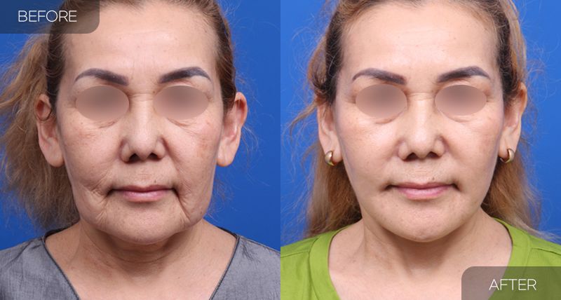 Gambar sebelum dan selepas pembedahan: Facelift Penuh 4 (Pandangan Hadapan)