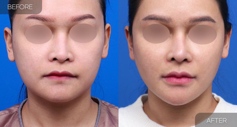 Gambar sebelum dan selepas pembedahan: Thread Lift 4 (Pandangan Hadapan)
