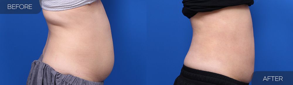 Gambar sebelum dan selepas pembedahan: Sedutan Lemak Abdomen 4 (Pandangan Sisi)