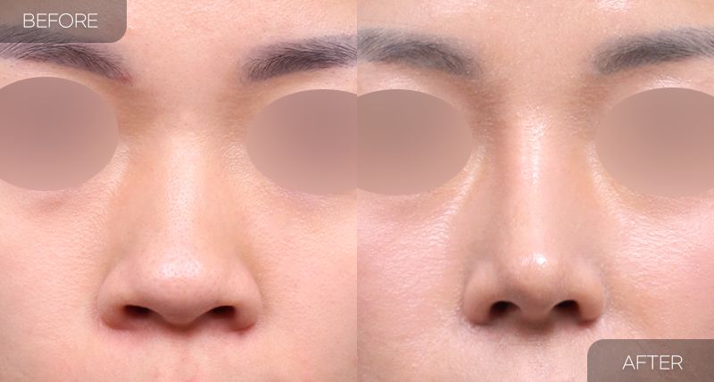 Gambar sebelum dan selepas pembedahan: Hidung Bulbus 4