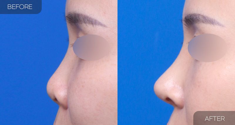 Gambar sebelum dan selepas pembedahan: Hidung Pendek 4