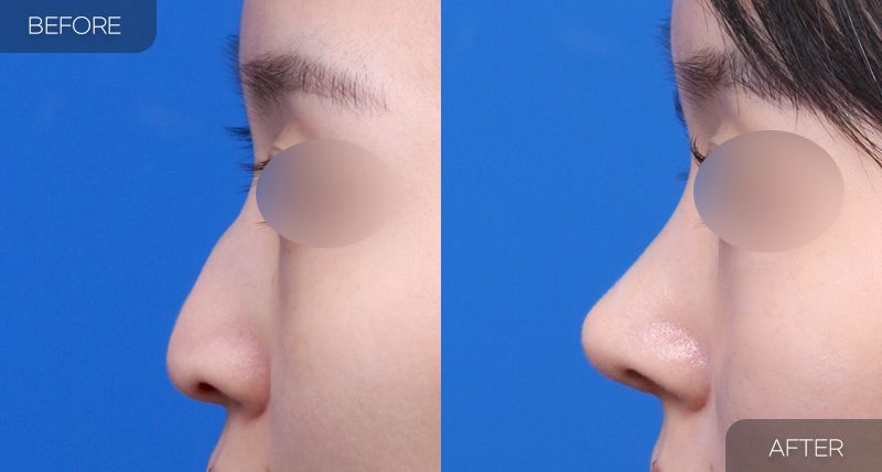 Gambar sebelum dan selepas pembedahan: Hidung Berbonggol 4