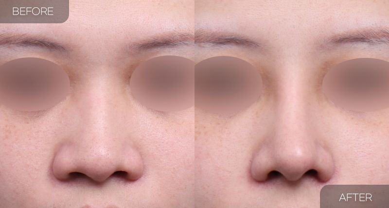 Gambar sebelum dan selepas pembedahan: Pengecilan Cuping Hidung 4