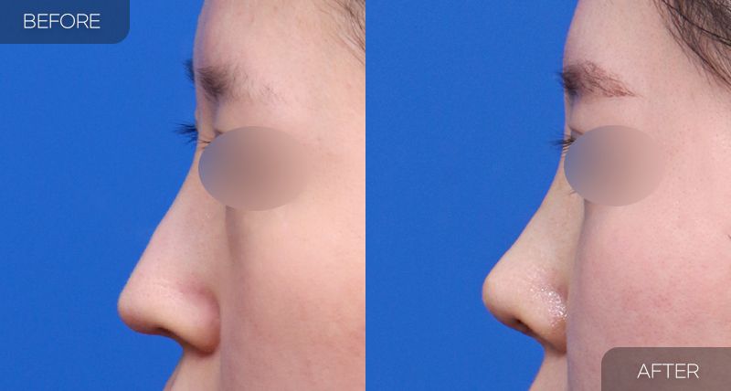 Gambar sebelum dan selepas pembedahan: Pembedahan Semula Hidung 4
