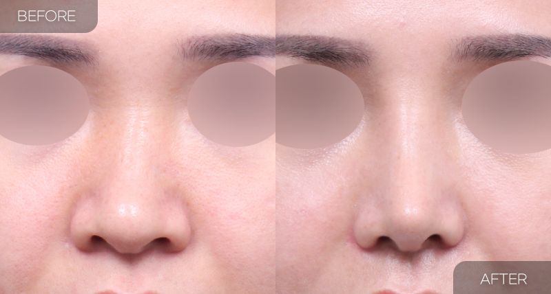 Gambar sebelum dan selepas pembedahan: Hidung Bengkok 4