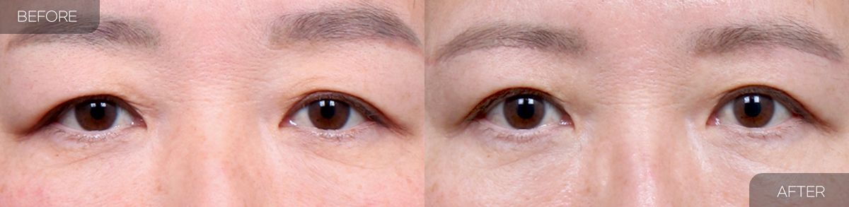 Gambar sebelum dan selepas pembedahan: Pengangkatan Kening 4