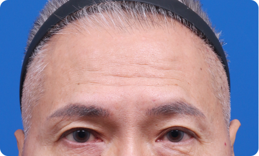 في حالة تجاعيد الجبهة العميقة 수술 전