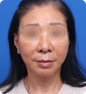全面部提升正面术后