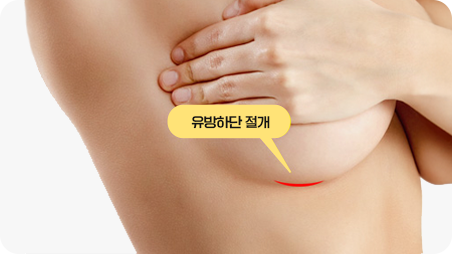 乳房下皱襞切口法