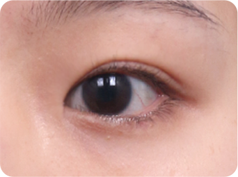 Epicanthoplasty STEP 01