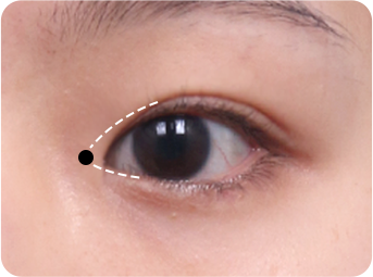 Epicanthoplasty STEP 02