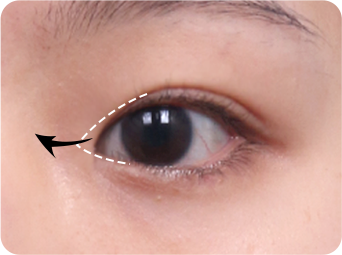 Epicanthoplasty STEP 03