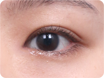 Epicanthoplasty STEP 04
