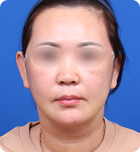 迷你提升正面术后