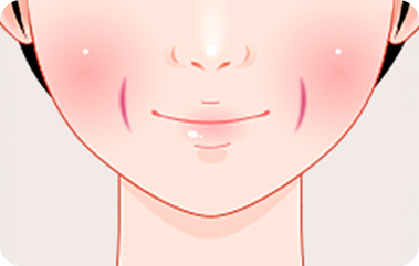 긴 보조개