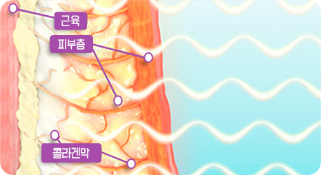STEP 02 고주파 전달
