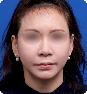 半面部提升正面术后