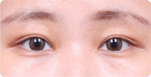 양쪽 라인이 다른 경우 수술 후