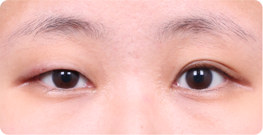양쪽 라인이 다른 경우 수술 전