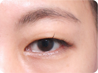 자연유착 STEP 01