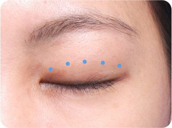 자연유착 STEP 02