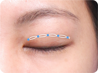 자연유착 STEP 03
