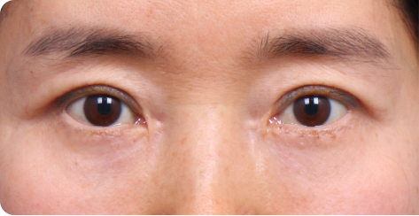 上睑成形术术后 1