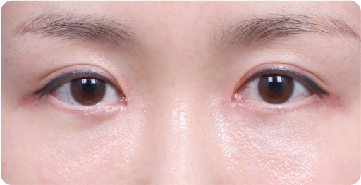 หลังผ่าตัดจัดเรียงไขมันใต้ตา+ปลูกถ่ายไขมันขนาดเล็ก