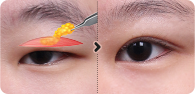 切开眼形矫正前后