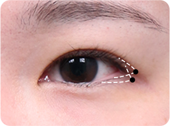 Dual Epicanthoplasty STEP 02