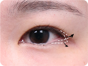 Dual Epicanthoplasty STEP 03